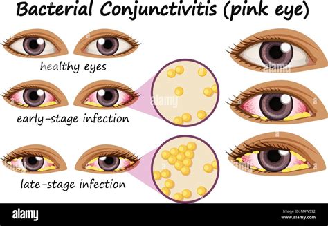 Bacterial Conjunctivitis Hi Res Stock Photography And Images Alamy