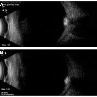 Optic nerve head drusen associated with an active choroidal... | Download Scientific Diagram