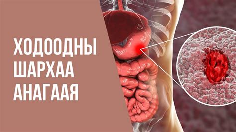 Ходоодны шархаа эмгүй анагаая - YouTube