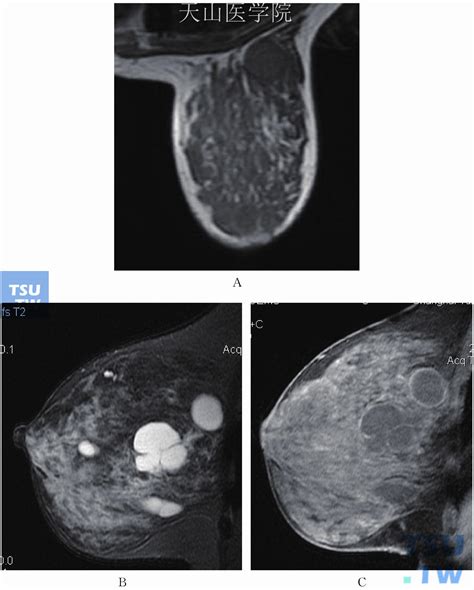 【附图】 乳腺常见病变的mri表现 乳腺肿瘤学 天山医学院