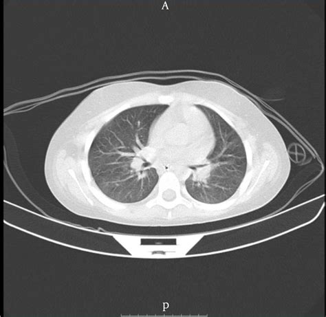 Bilateral Ground Glass Opacities On Chest Ct Scan Download Scientific Diagram