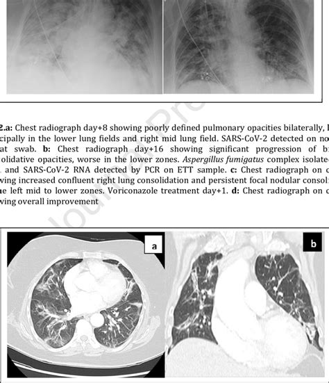 Contrast Enhanced Computed Tomography Chest On Day 45 Showing