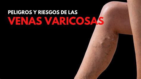 Peligros Ocultos De Las Venas Varicosas Elite Vein Clinic Es