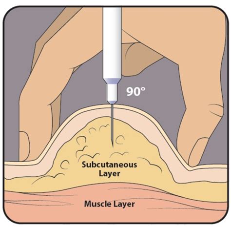 Skills Lab Intramuscular Injection Flashcards Quizlet