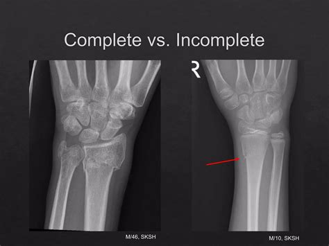 Fracture Management and Immobilization Techniques.pptx