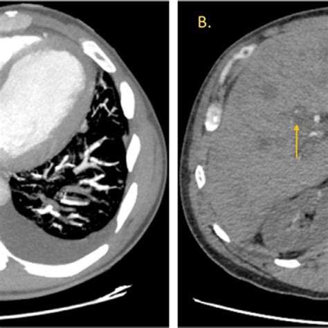 Cta Chest Demonstrating Acute Pulmonary Embolism Involving Download Scientific Diagram