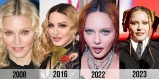 Madonna Underwent Facelift Surgery | Plastic Surgery Journey | Bizrahmed