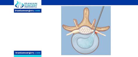 Herniated Disc Surgery Recovery Time Herniated Disc Surgery Cost