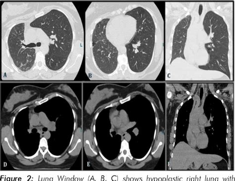 Figure From Proximal Interruption Of Right Pulmonary Artery In An