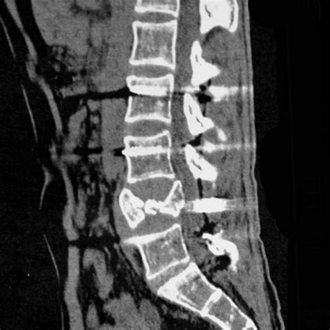 Computed Tomography Scan Of The Lumbar Spine Showing An L4 Burst