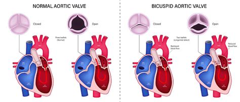 Perbedaan Katup Aorta Normal Dan Katup Aorta Bikuspid Stenosis Aorta ...