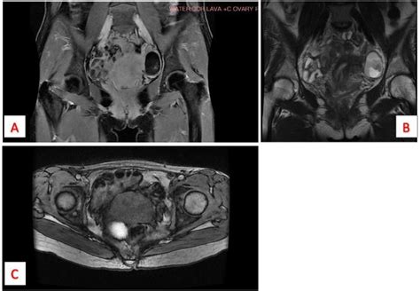 Laparoscopic Removal Of A Dermoid Cyst In One Ovary And An Endometrioma