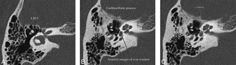 Retrospective Review Of Otic Capsule Contour And Thickness In Patients With Otosclerosis And