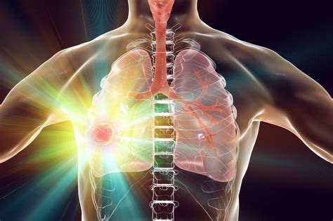 Study Looks at Survival in Metastatic NSCLC Treated With Immunotherapy ...