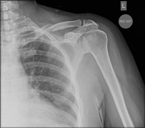 Pathological Clavicle Fracture Radiology Case Radiopaedia Org