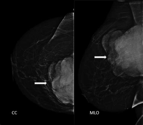 -Digital mammography (CC and MLO views) showed an irregular ...