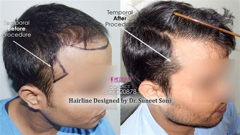 Top 5 Hair Transplant Surgeons in India