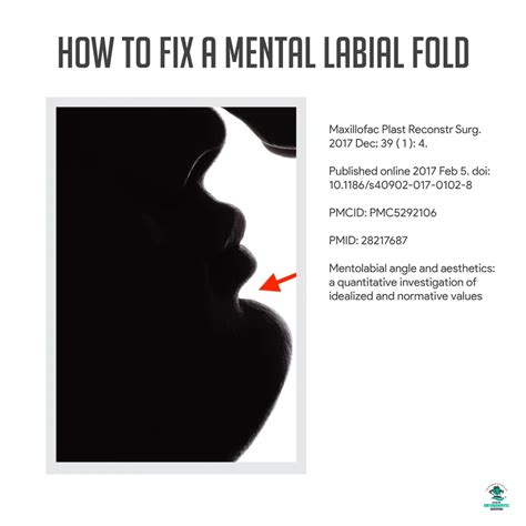 Fixing a Mental Labial Fold