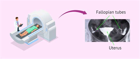 Types Of Hysterosalpingography Advantages Risks And Limitations