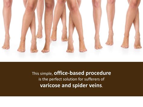 PPT Spider Veins Treatment Chicago Veins Without Surgery PowerPoint