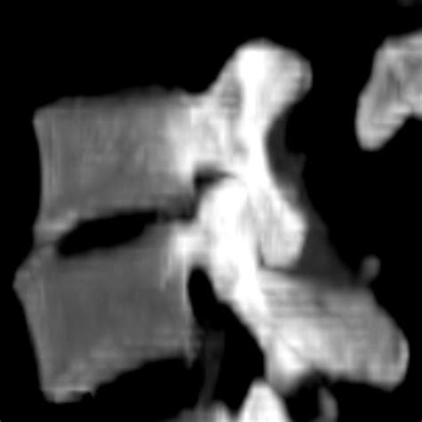 MIP reconstruction. Sagittal view of lumbar vertebrae. | Download Scientific Diagram