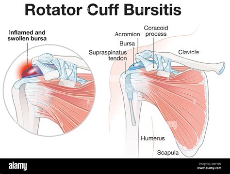 Illustration Montrant La Bursite De La Coiffe Des Rotateurs Photo Stock