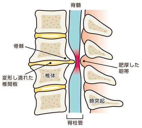 変形性腰椎症 セカンドオピニオンcom