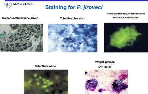 Mayo Clinic Infectious Diseases On Twitter Fungal Disease Awareness Week Pneumocystis