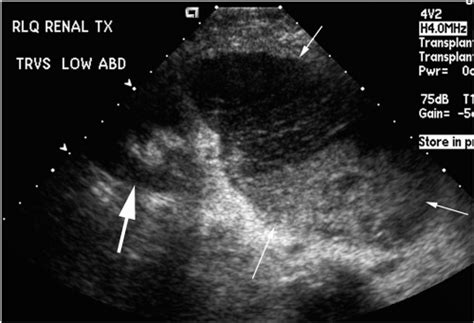 Imaging Of The Renal Transplant Recipient Abdominal Key