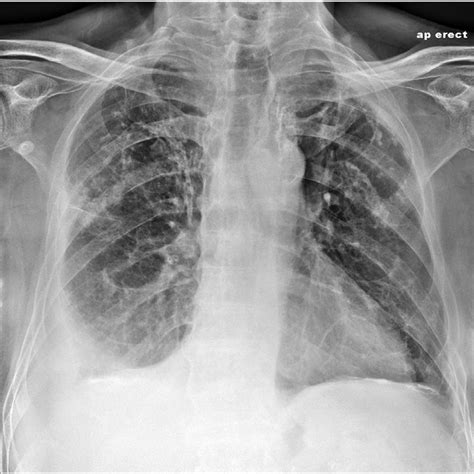 Pleural Effusion Ct Scan