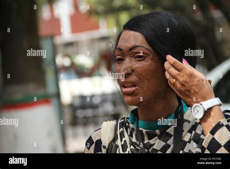 Female Victim Acid Hi Res Stock Photography And Images Alamy