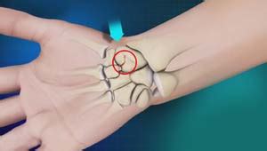 Scaphoid Fracture Treatment Irvine Ca Hand Pain Laguna Woods