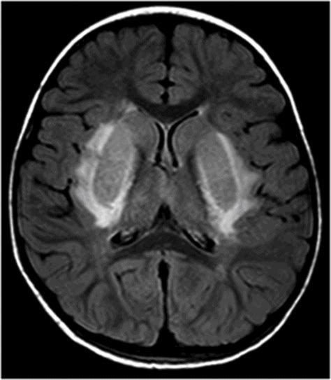 Basal Ganglia Axial Ct