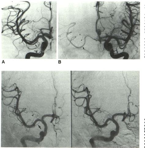 Figure 5 from form of the recurrent artery of Heubner? Accessory middle ...