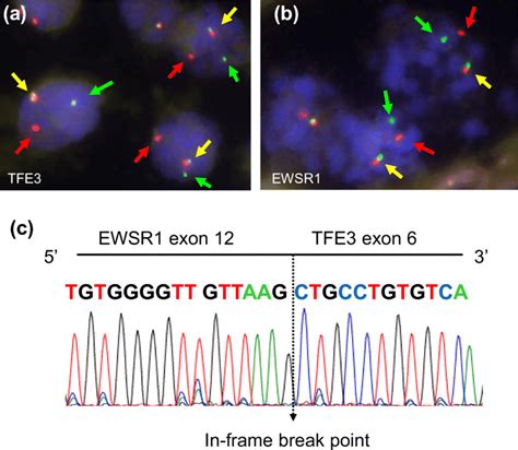 Analysis Of EWSR1 TFE3 Fusion A Dual Color Break Apart FISH Assays