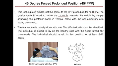 45 Degree Forced Prolonged Position For Left Apogeotropic Posterior