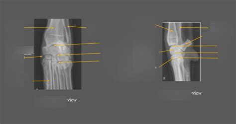 carpus radiographs Diagram | Quizlet