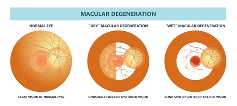 Macular Degeneration Treatment - What Are the Stages of Macular ...