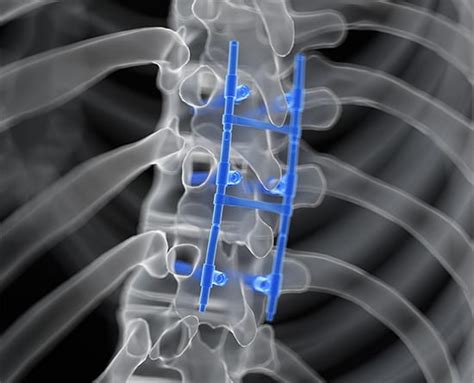 Lumbar Fusion | Houston, TX | Modern Spine