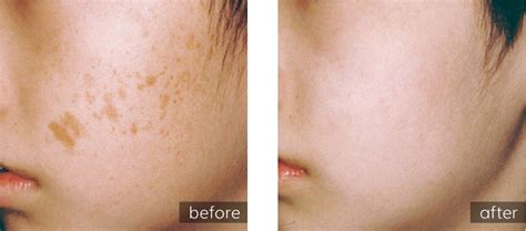 Laser Skin Resurfacing Nyc Renew Skin Dermatology And Laser Group