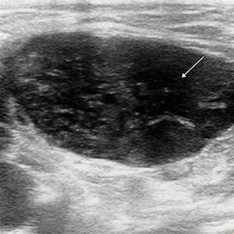 Groin Lymph Nodes Ultrasound