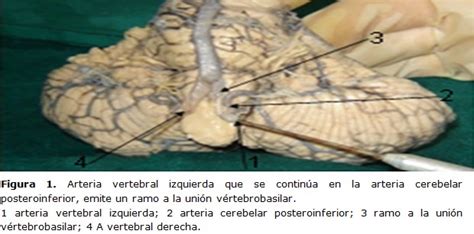 Ramas De La Arteria Vertebral