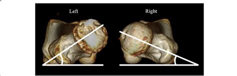 plain  ct  anteversion angle   femoral necks leftright