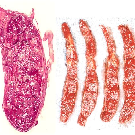 Microscopic fibrin deposit in intervillous space of a FGR placenta ...