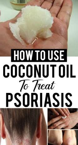 How To Use Coconut Oil For Psoriasis And Scalp Psoriasis Coconut Oil