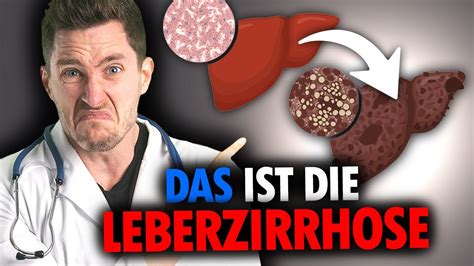 Leberzirrhose DARUM Solltest DU Deine LEBER Gut Behandeln YouTube