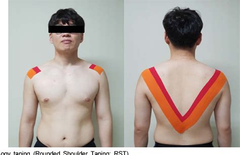 Figure 2 From The Effects Of Kinesiology Taping And Pectoralis Minor