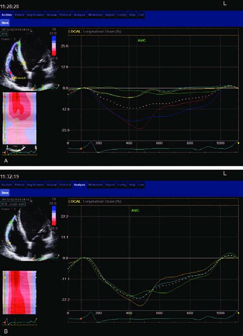 Example of RV 2D strain assessment. (A) 6-segments model of RV free ...