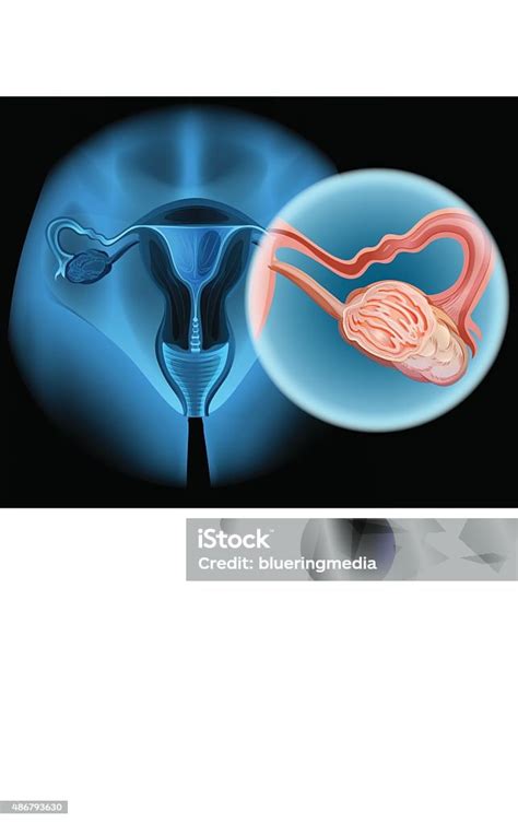 Diagram Kanker Ovarium Pada Wanita Ilustrasi Stok Unduh Gambar