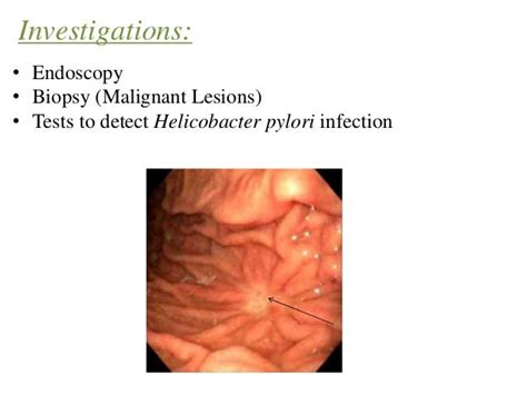 Management of Acid Peptic Disease